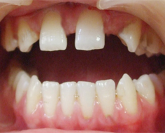 前牙稀疏到底有哪些危害