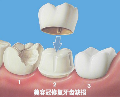 牙齿缺损怎么办