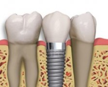 单颗牙缺失采用种植牙修复有什么好处