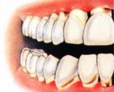 老年人牙齿松动的原因是什么