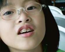 儿童牙齿正畸的注意事项有哪些