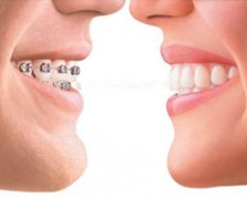 牙齿矫正有哪些方法