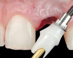前牙种植牙的优势是什么