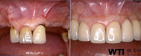 牙齿松动种植案例