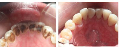 牙结石护理案例
