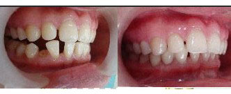 郑州唯美单颗牙齿缺失治疗前后对比