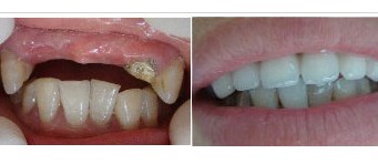郑州唯美多颗牙齿缺失后治疗前后对比