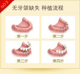 种植牙流程
