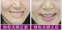 郑州矫正牙齿哪个医院更好?