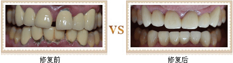 烤瓷牙修复前后对比图