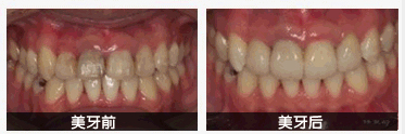 牙齿修复前后对比图