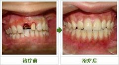 门牙修复选择哪种烤瓷牙好