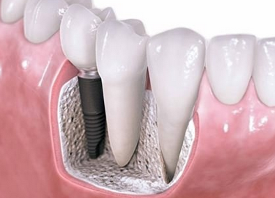 种植牙的修复过程需要几个步骤