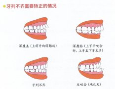 儿童牙齿不齐怎么预防