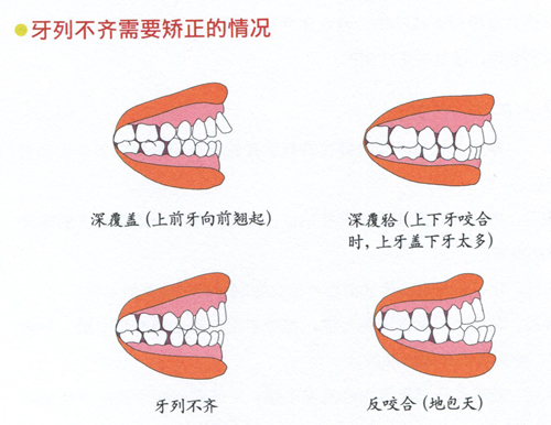 儿童牙齿不齐怎么预防