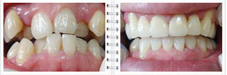 成人牙齿拥挤矫正方法