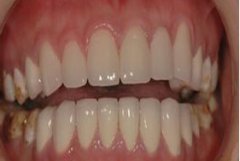 洗牙能让牙齿变白吗