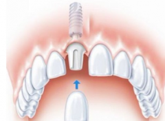 种植牙材料选择